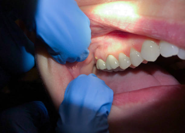 Emergency Gum Pain Relief in PA